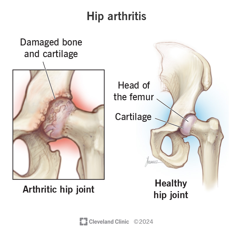 Hip Replacement Surgery
