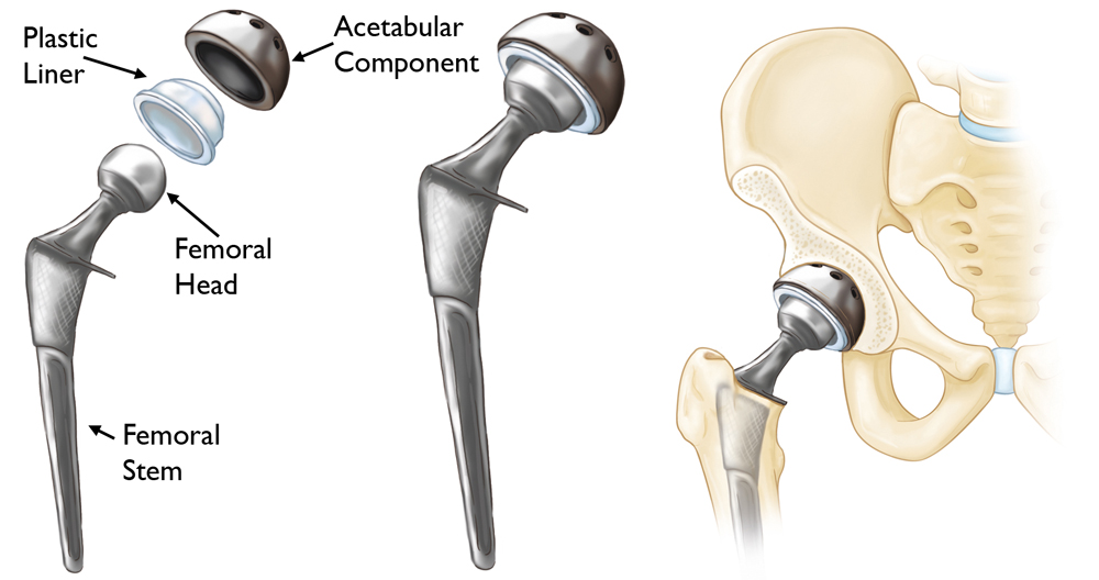 Hip Replacement Recovery
