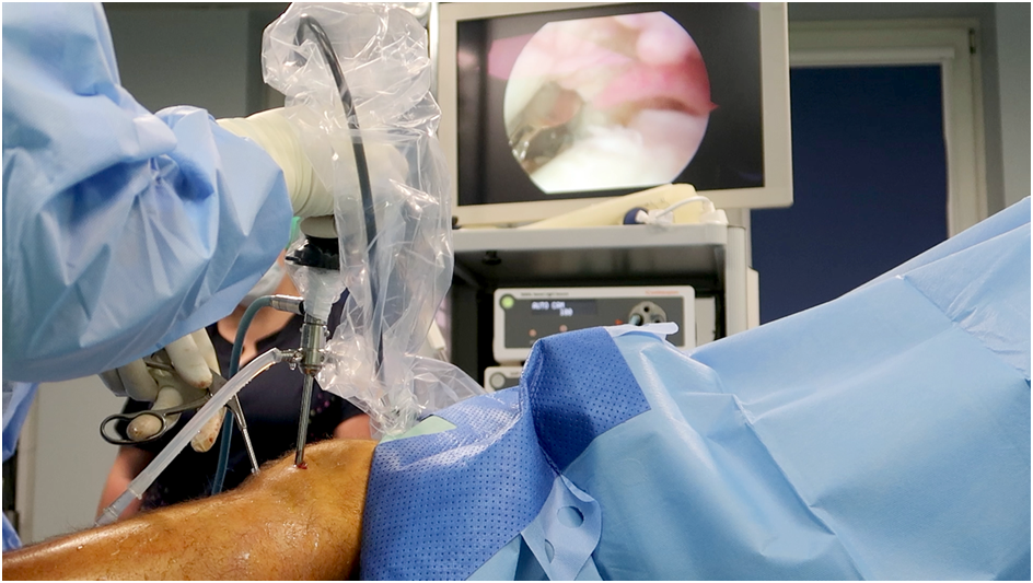 Knee Arthroscopy Recovery