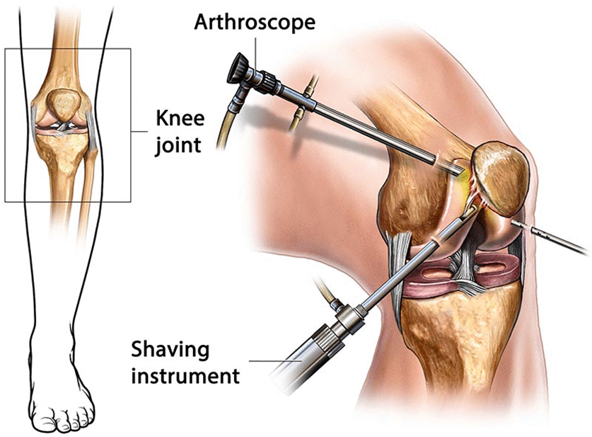 Knee Arthroscopy Procedure