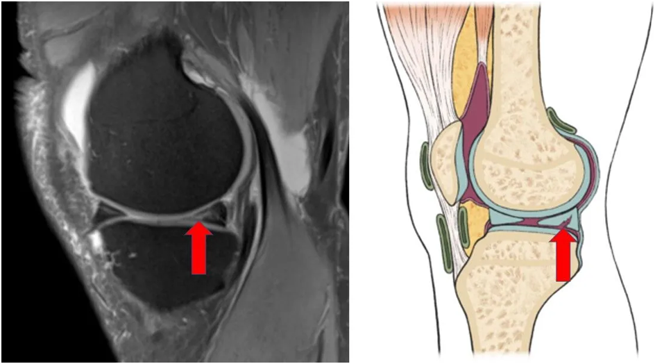 Meniscus Tear Repair Surgery