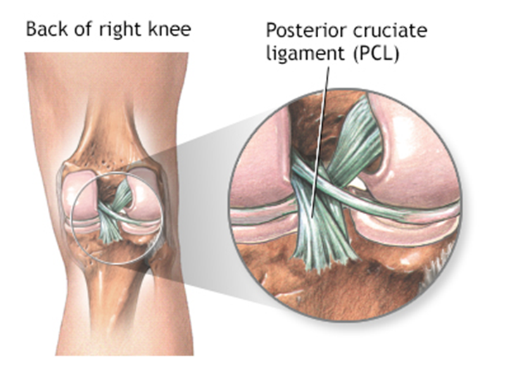 PCL Tear Diagnosis