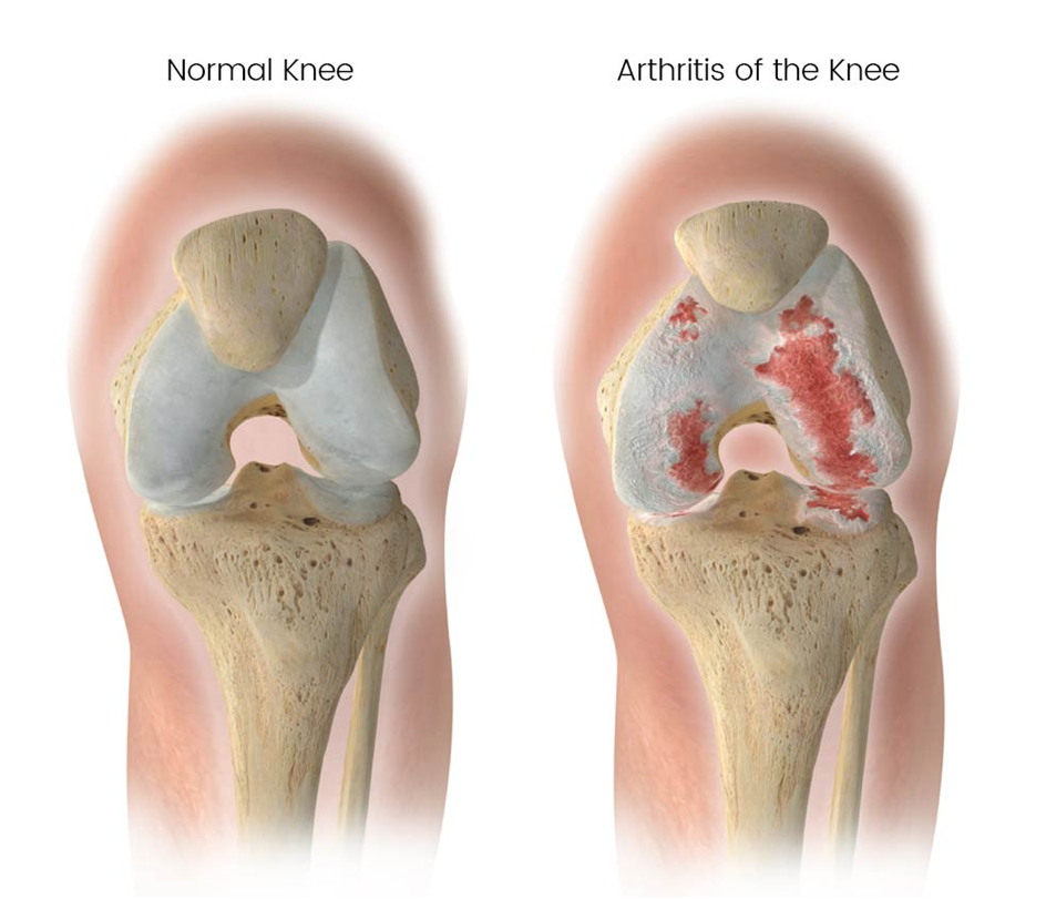 Knee Replacement Surgery