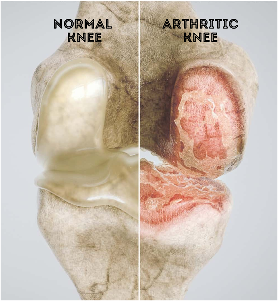 Preparation for Knee Surgery