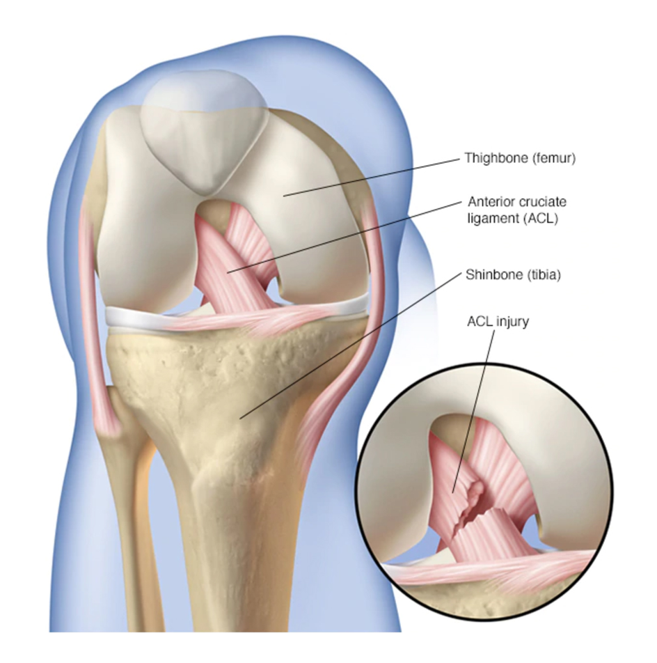 ACL Tear Injury