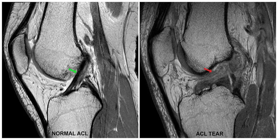 Causes of ACL Tear