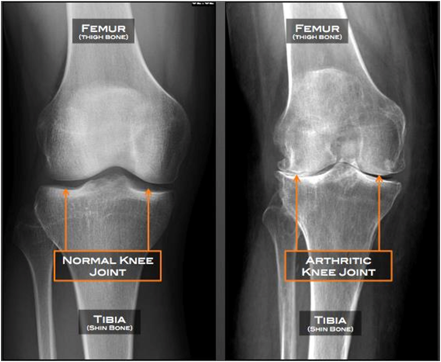 Treatment for Knee Osteoarthritis