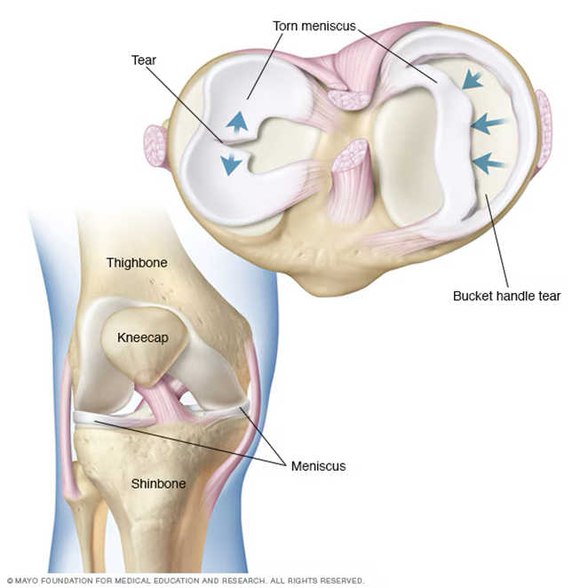 Symptoms of Meniscus Tear