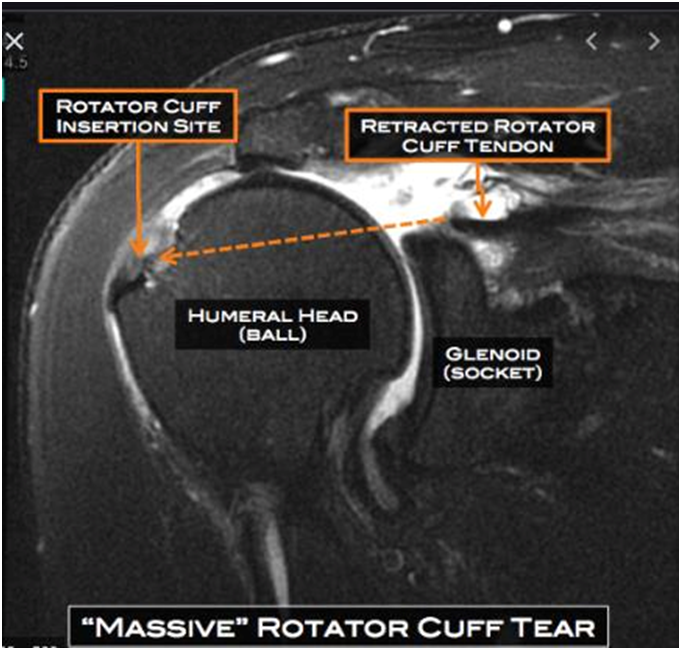 Rotator Cuff Treatment