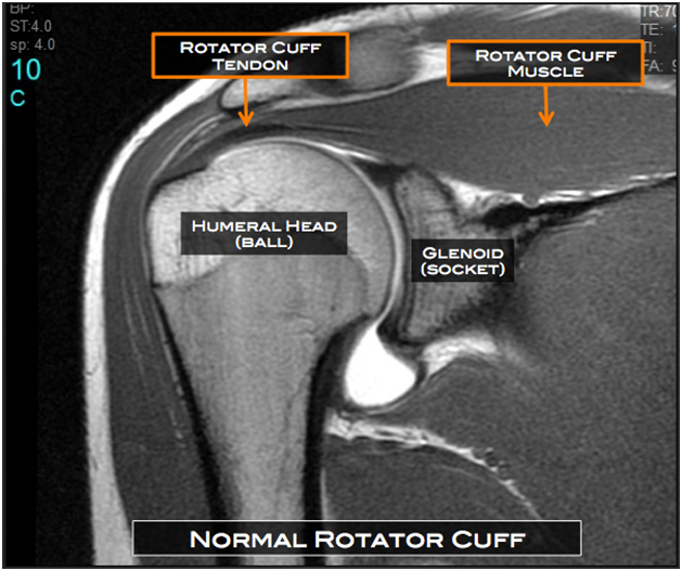 Symptoms of Rotator Cuff Tear