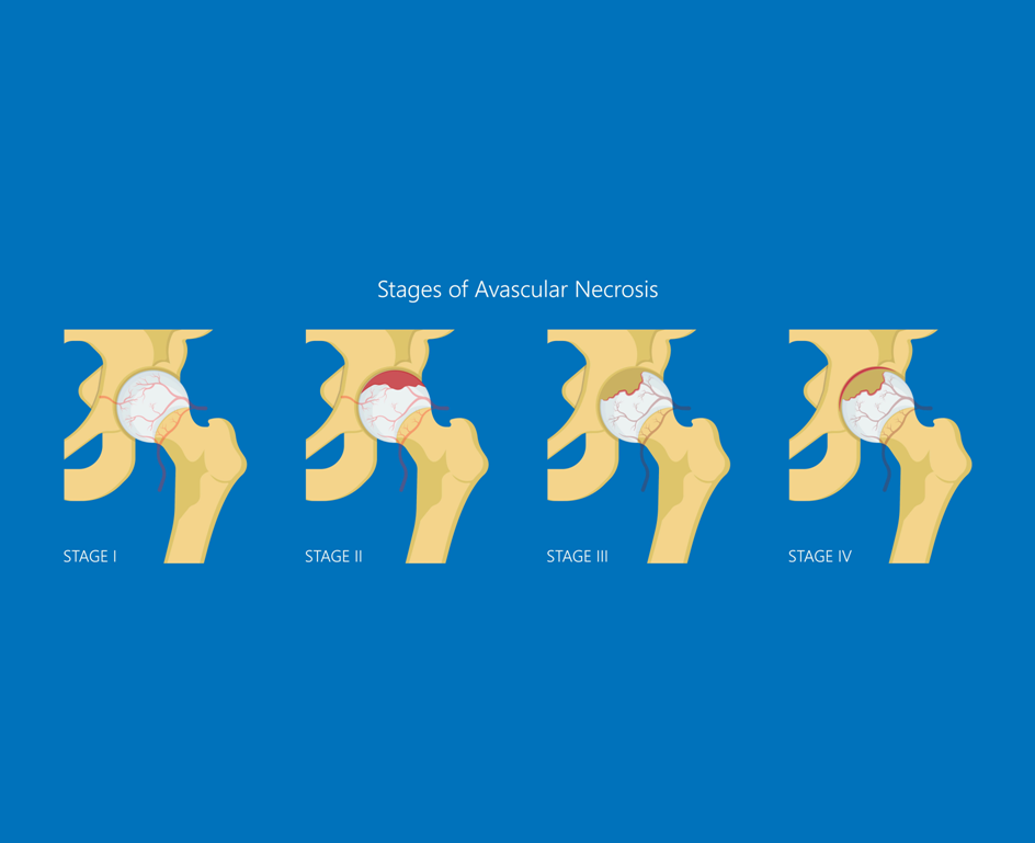 AVN Causes