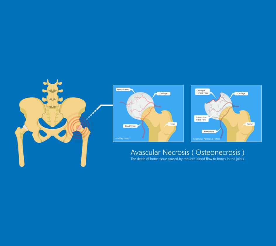 Avascular Necrosis Overview