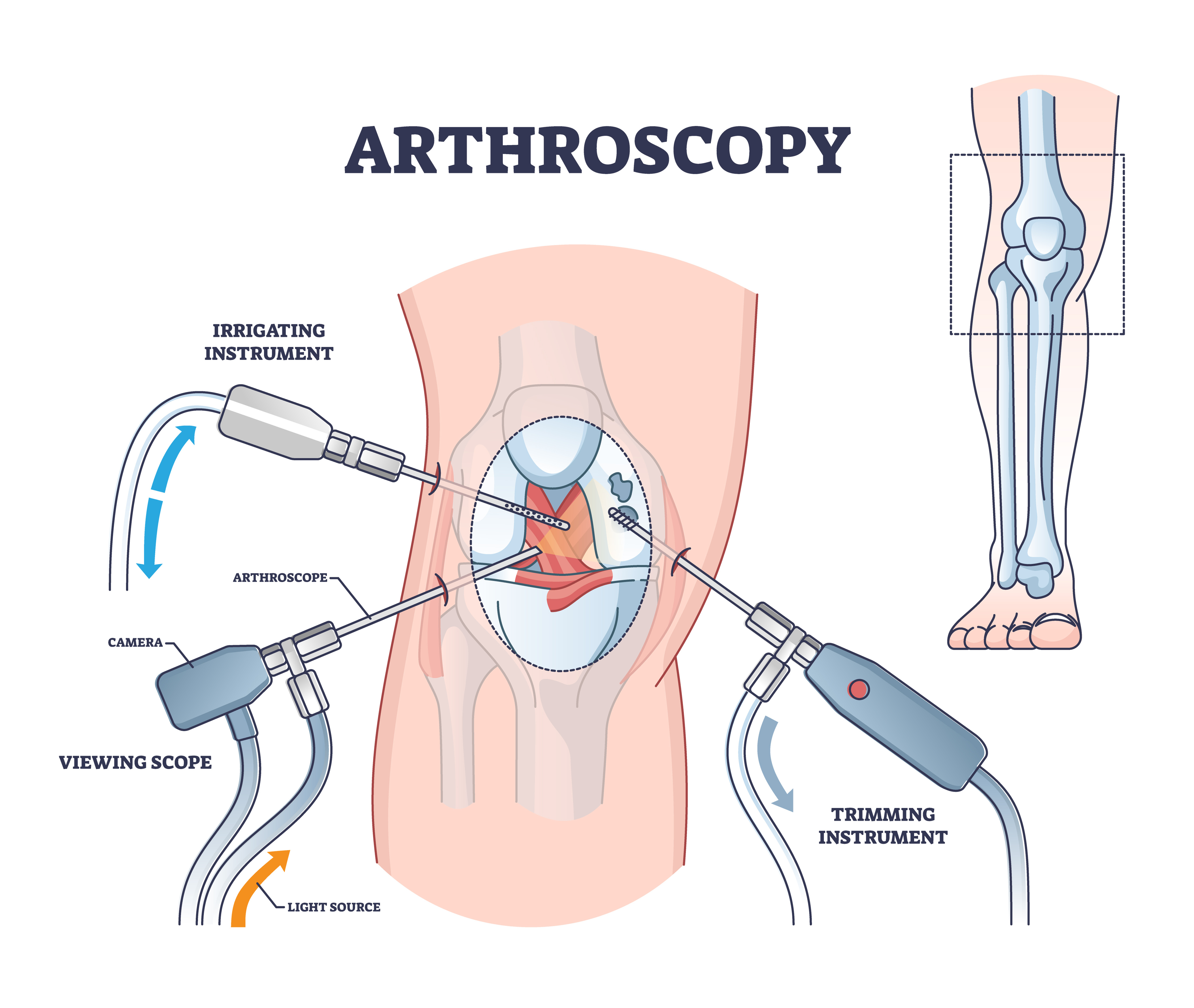 Knee Arthroscopy Surgery