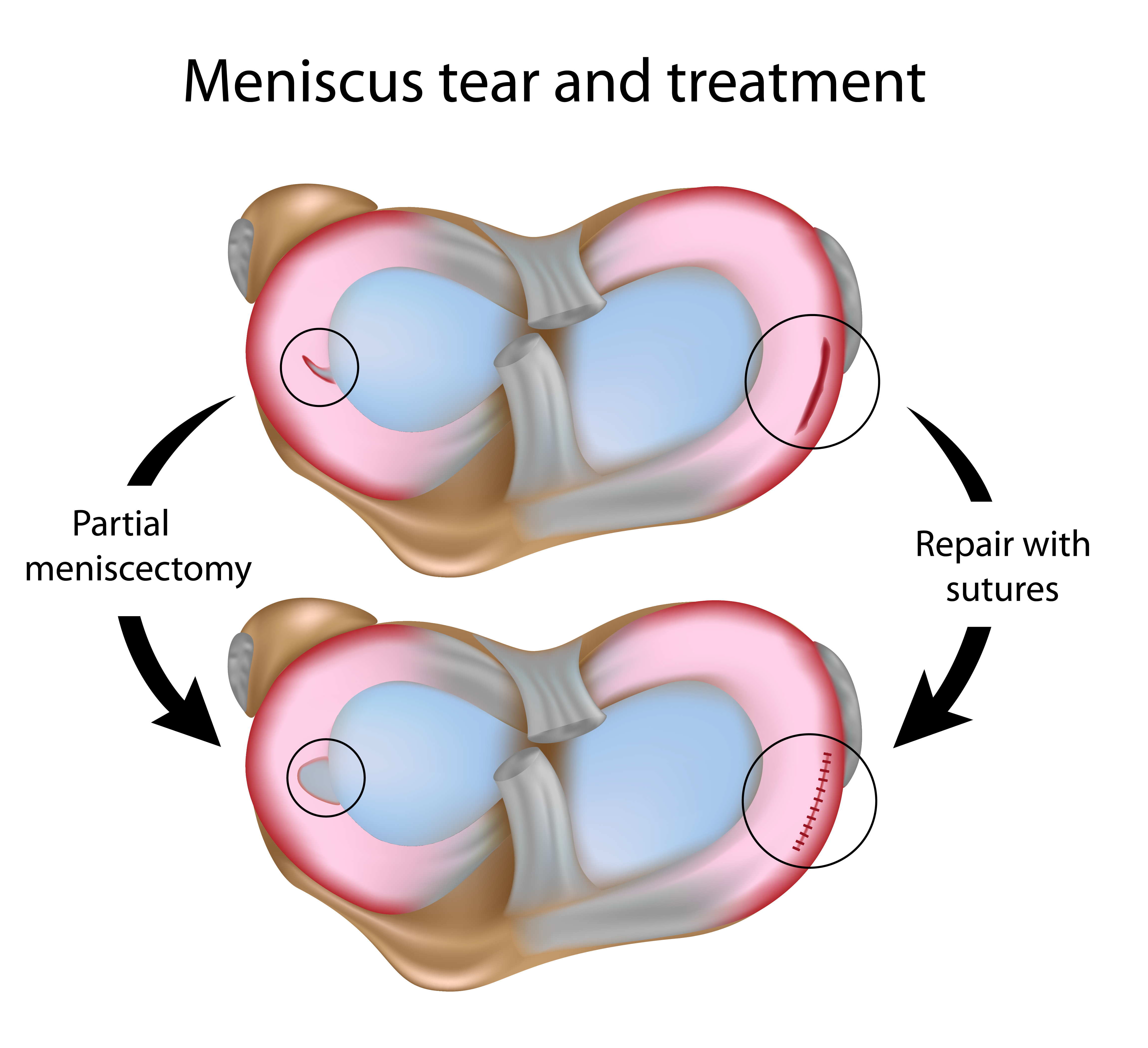Meniscus Tear Recovery