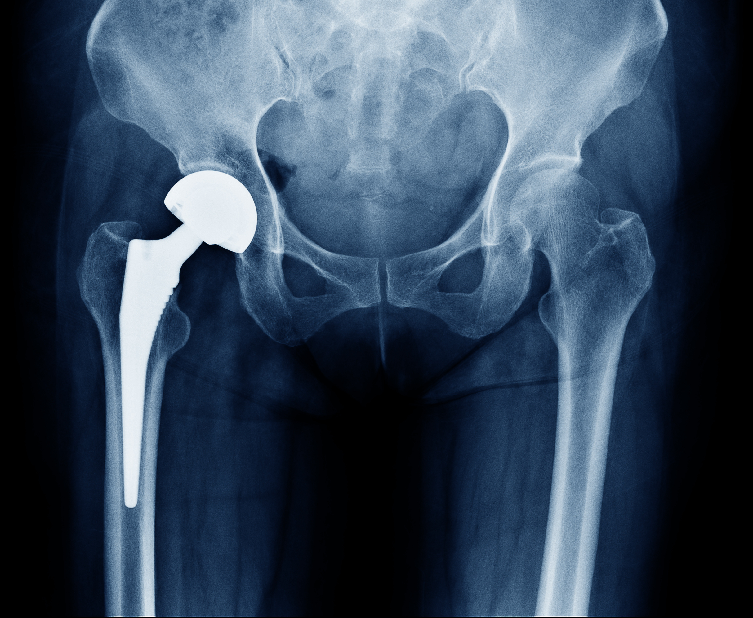 Hip Replacement Recovery