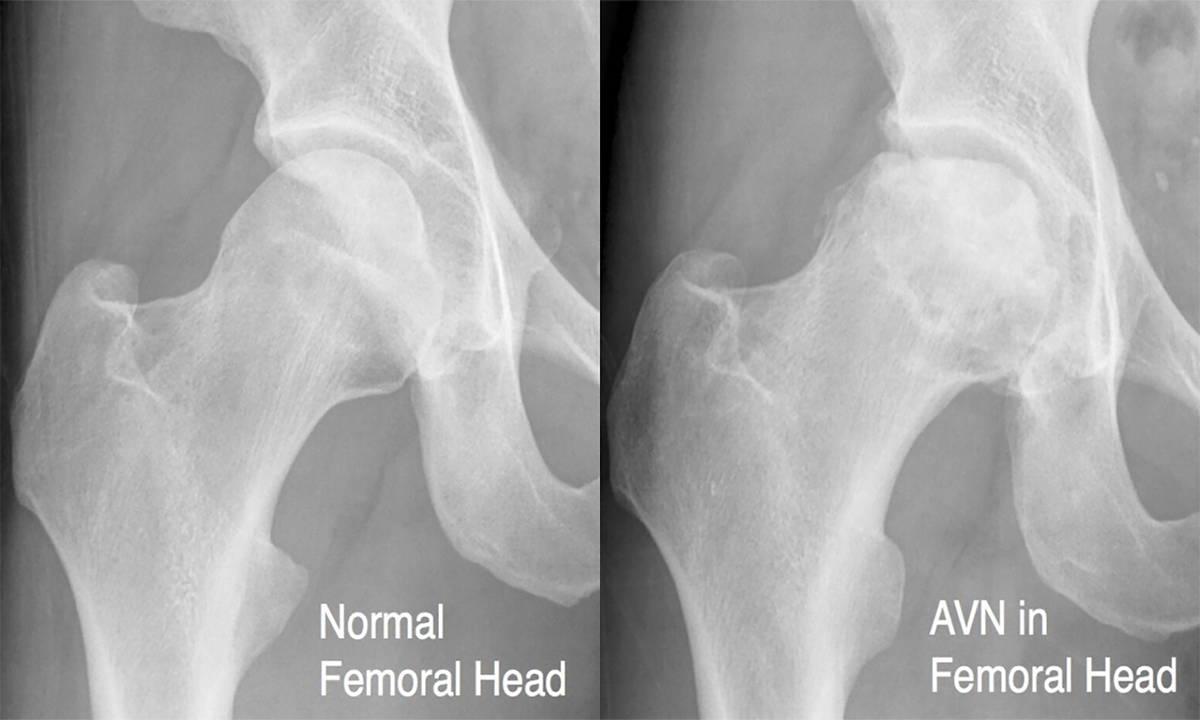 AVN Treatment Options