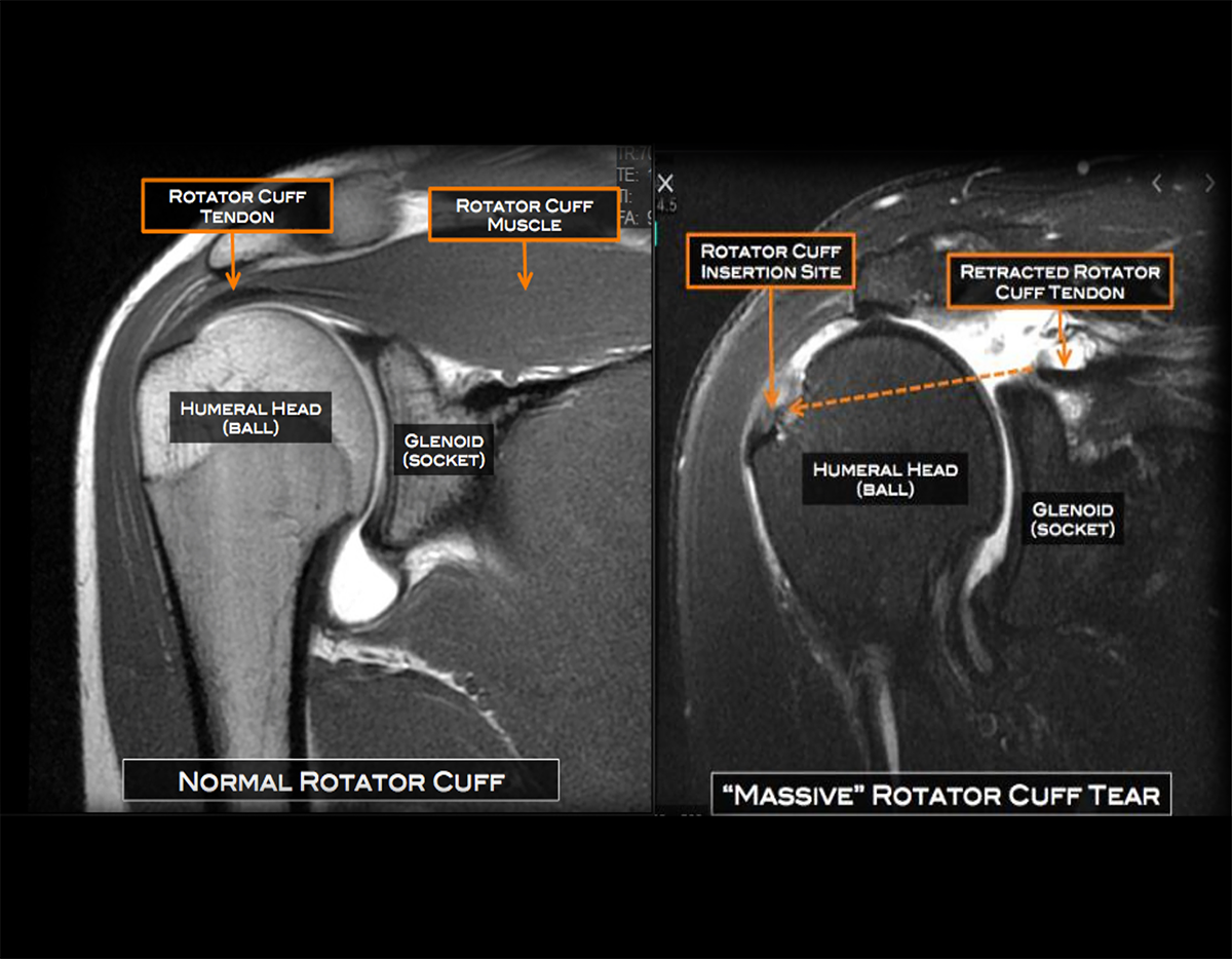 Shoulder Rotator Cuff Tear