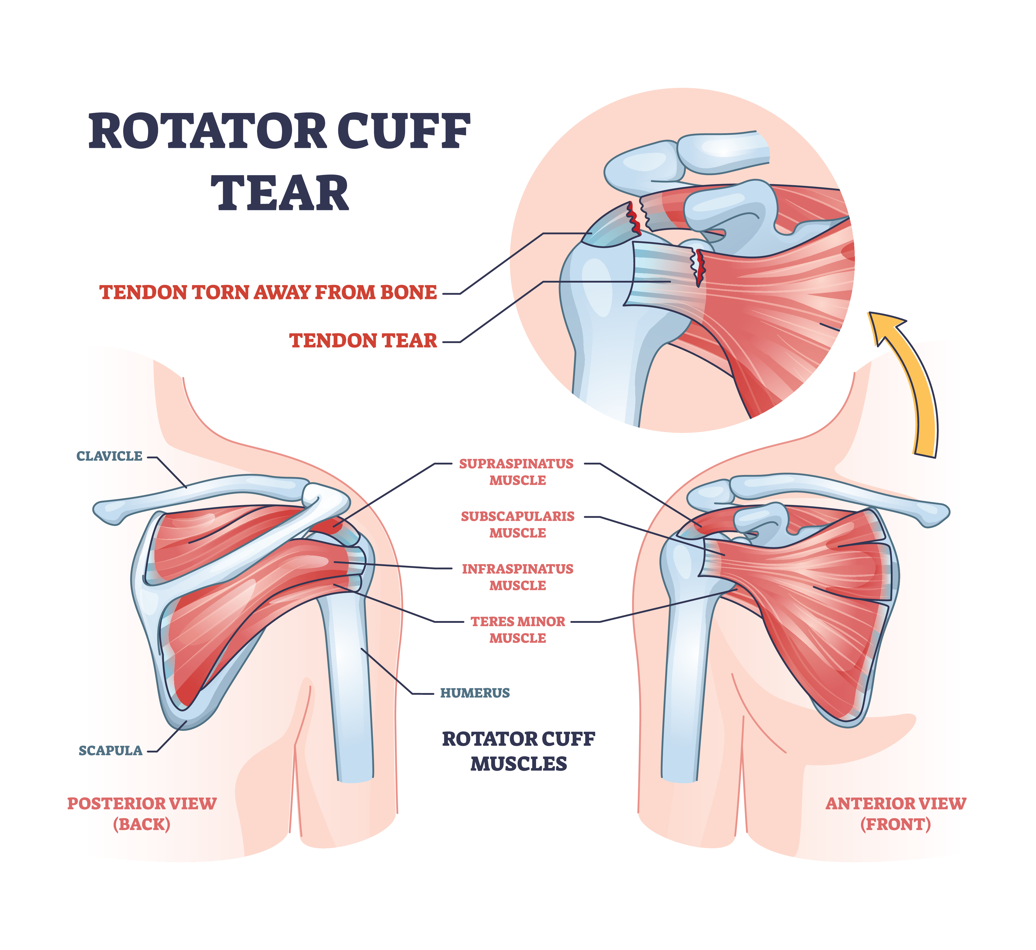 Causes of Rotator Cuff Tear