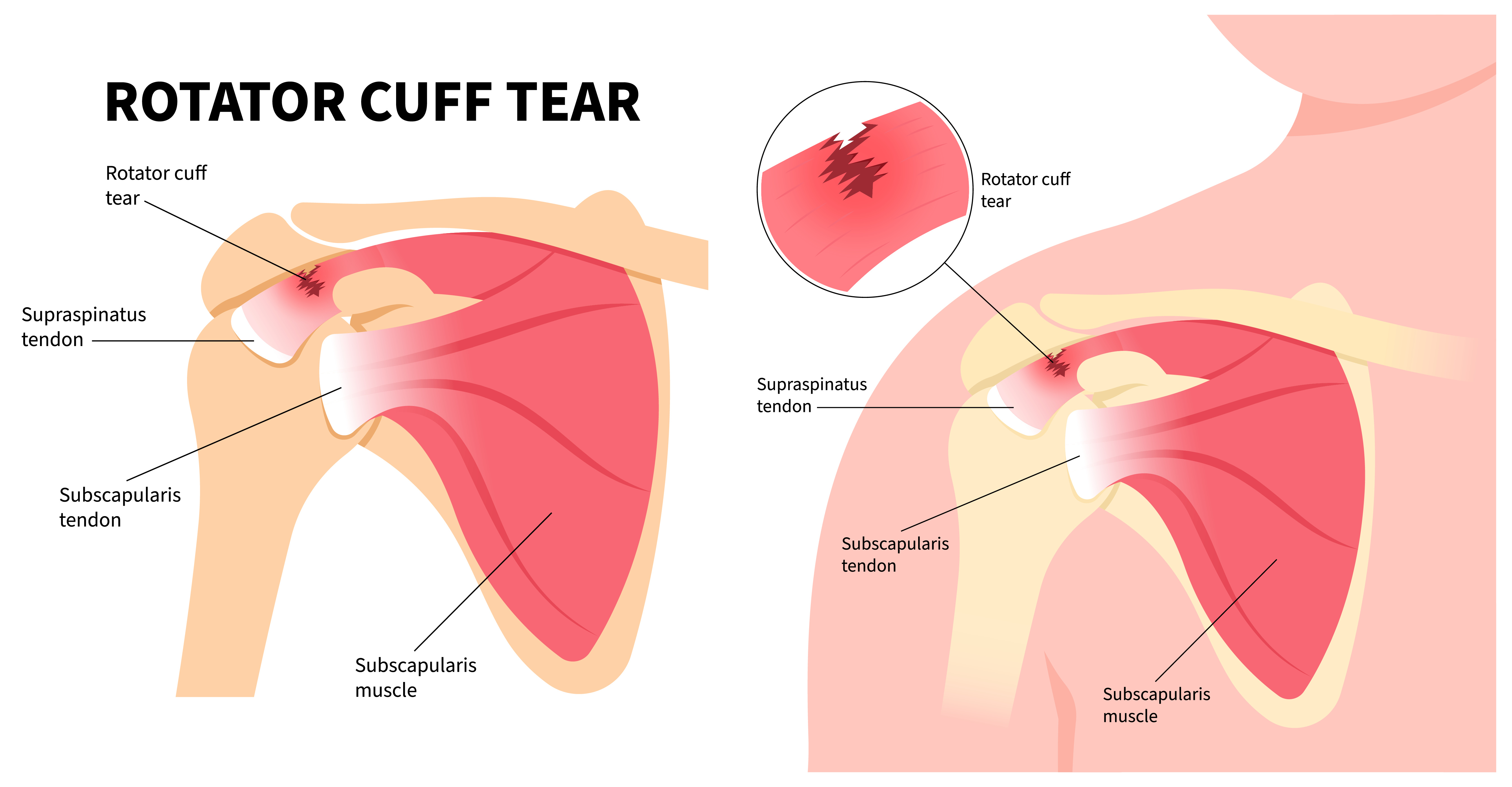 Causes of Rotator Cuff Tear